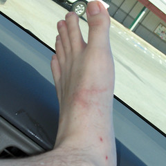 My foot: stung by a jellyfish